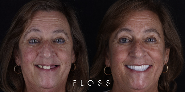 What are Teeth Implants img